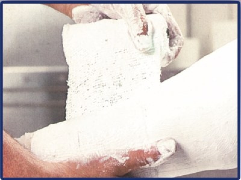 Casting and Bandaging By PharmaPlast